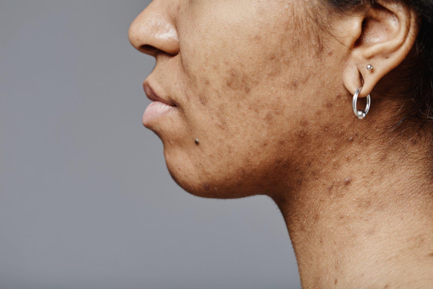 Perfil de un rostro con manchas en la piel